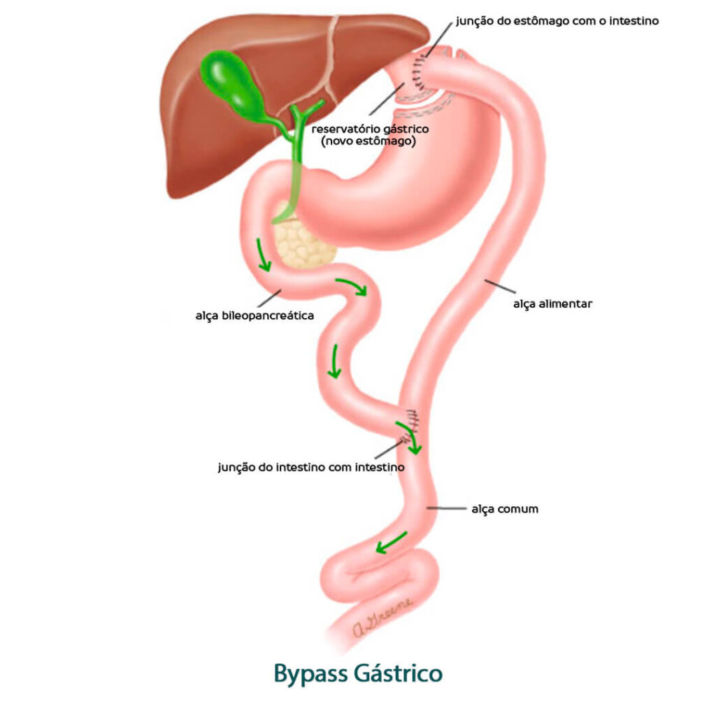 bypass gástrico